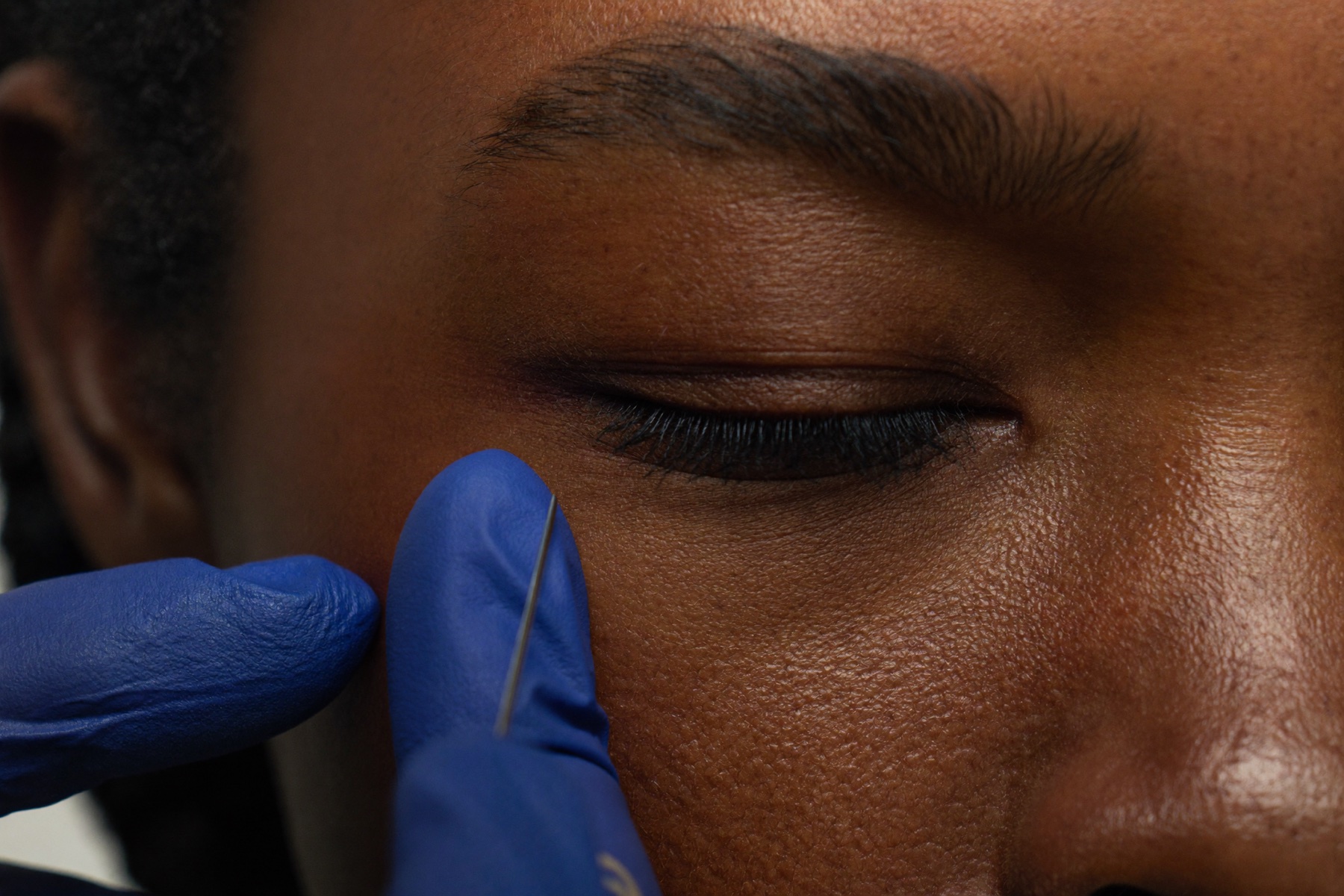 Botox for crow's feet
