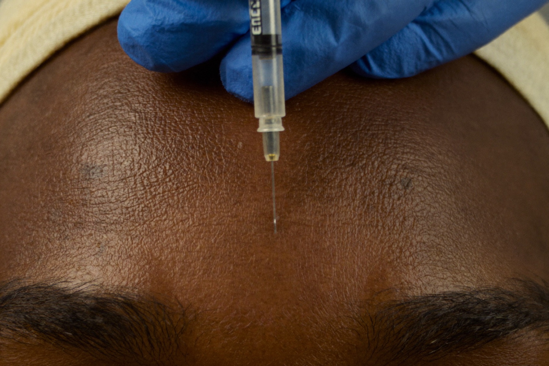 Botox for frown lines (the '11s')